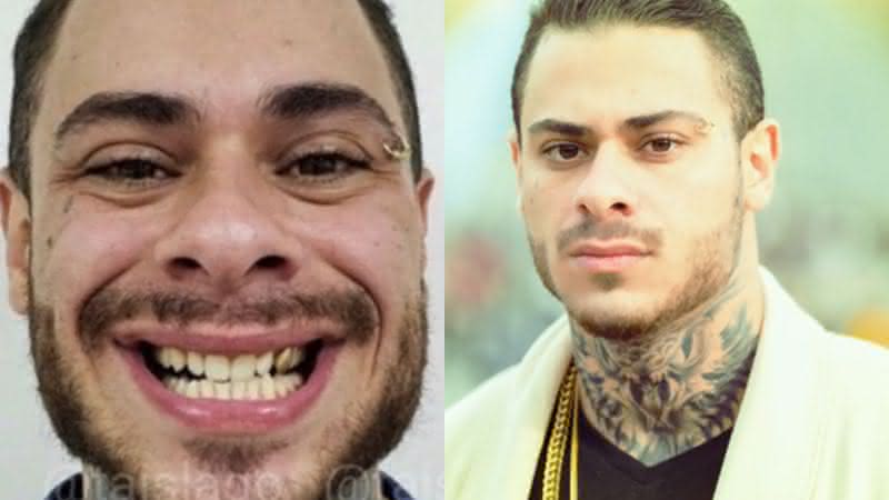 Leo Stronda colocou lente de contato no dente - Instagram