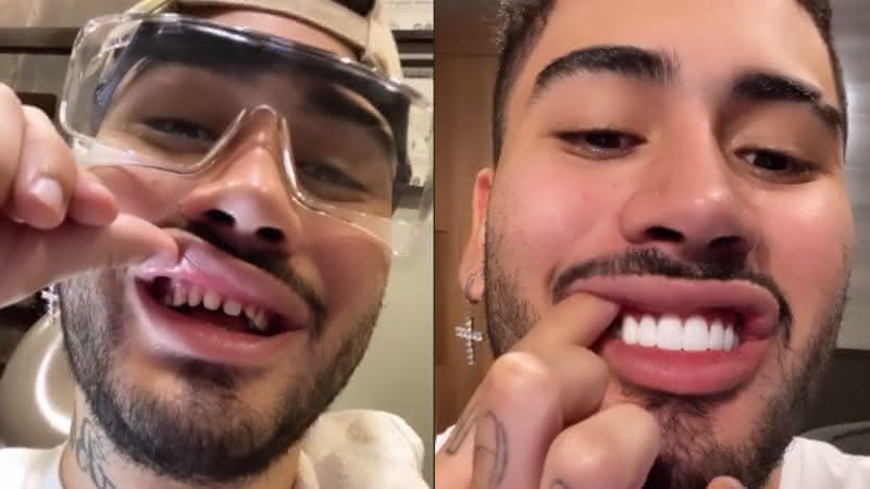 Kevinho trocou as lentes dos dentes - Instagram