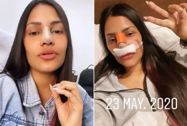 Após realizar rinoplastia, Flayslane publica foto e exibe resultado - Instagram