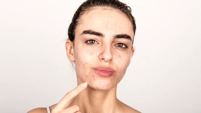 Acne em diferentes fases da vida: entenda - Freepik