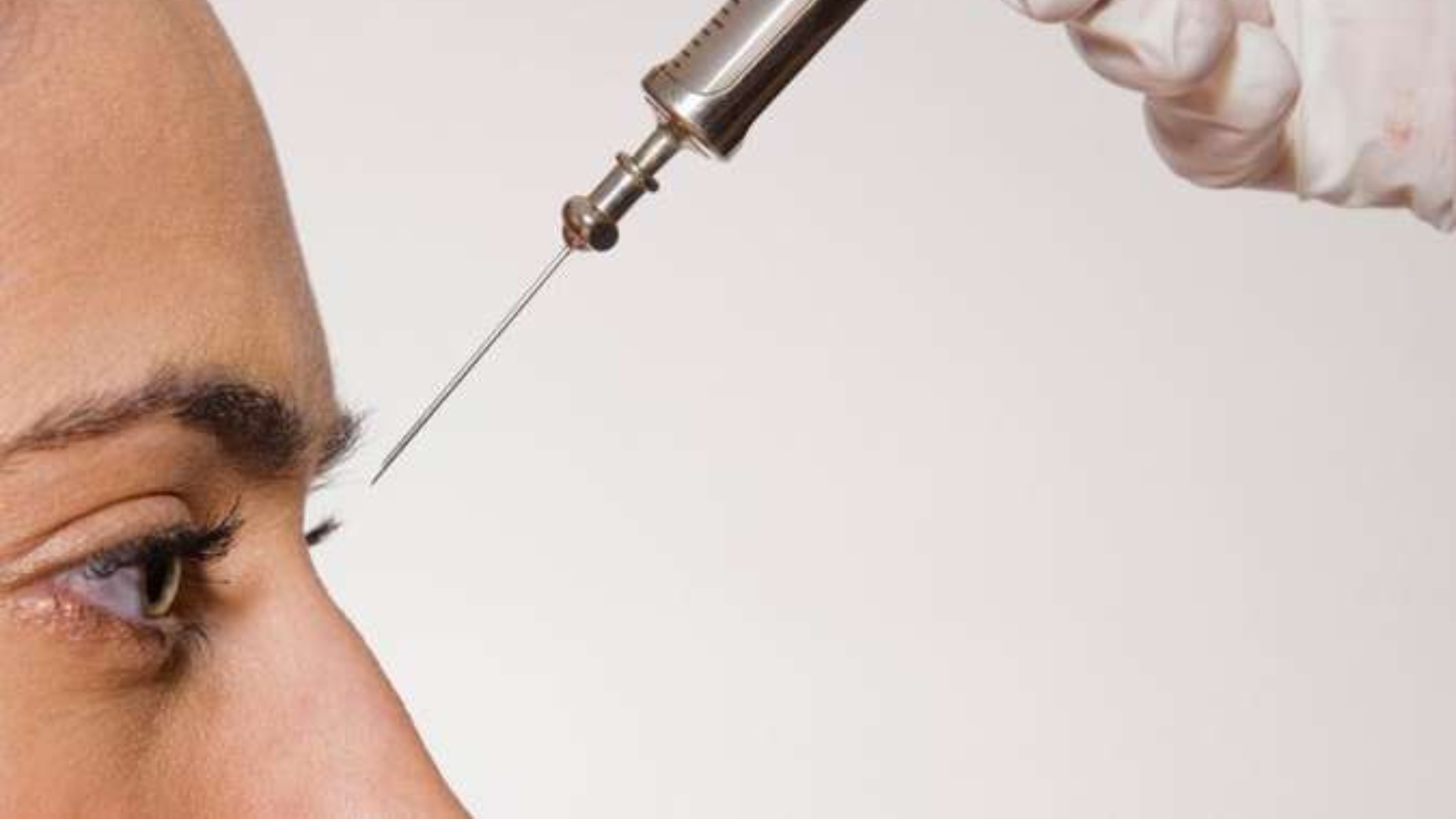 Conhece a rinomodelação? Procedimento que modifica o formato do nariz sem cirurgia plástica
