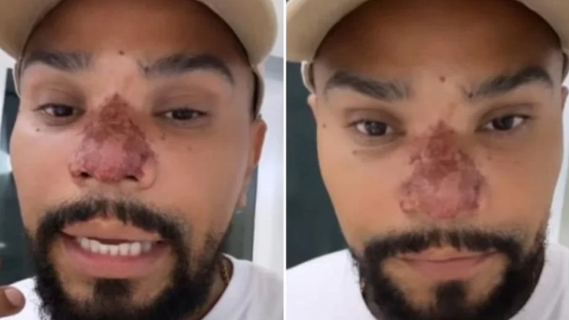 Naldo Benny assusta seguidores após princípio de necrose no nariz