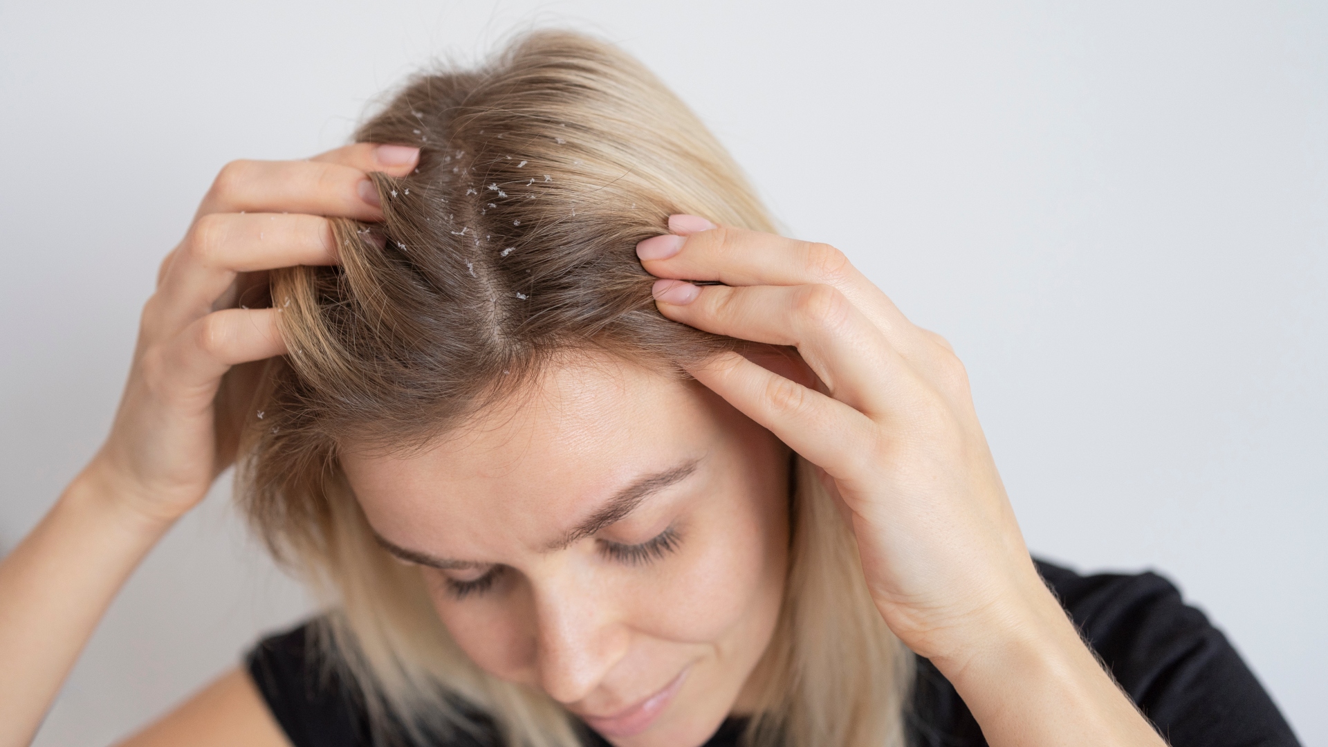 O inverno aumenta a caspa? Dermatologista desmistifica