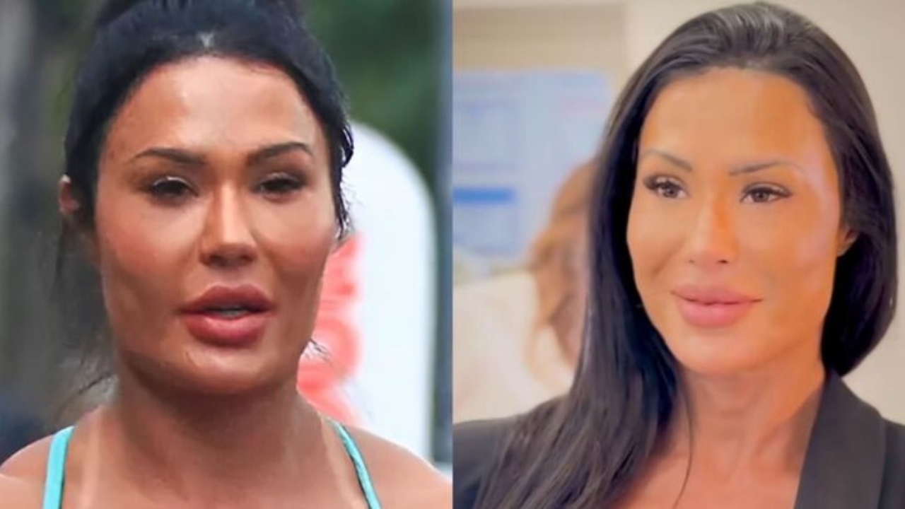 Gracyanne Barbosa retira preenchimento facial e recebe elogios nas redes