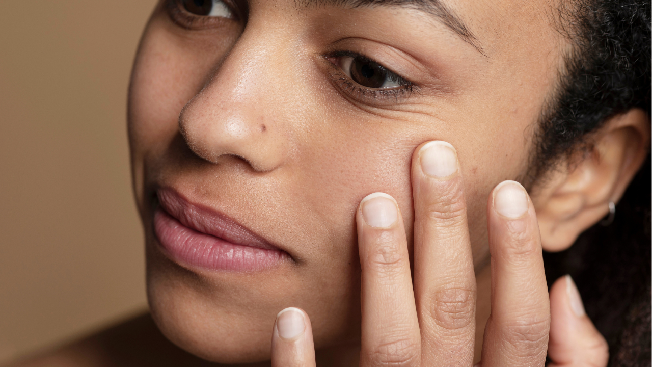 Mancha escura é Melasma? Dermatologista explica a importância do diagnóstico correto