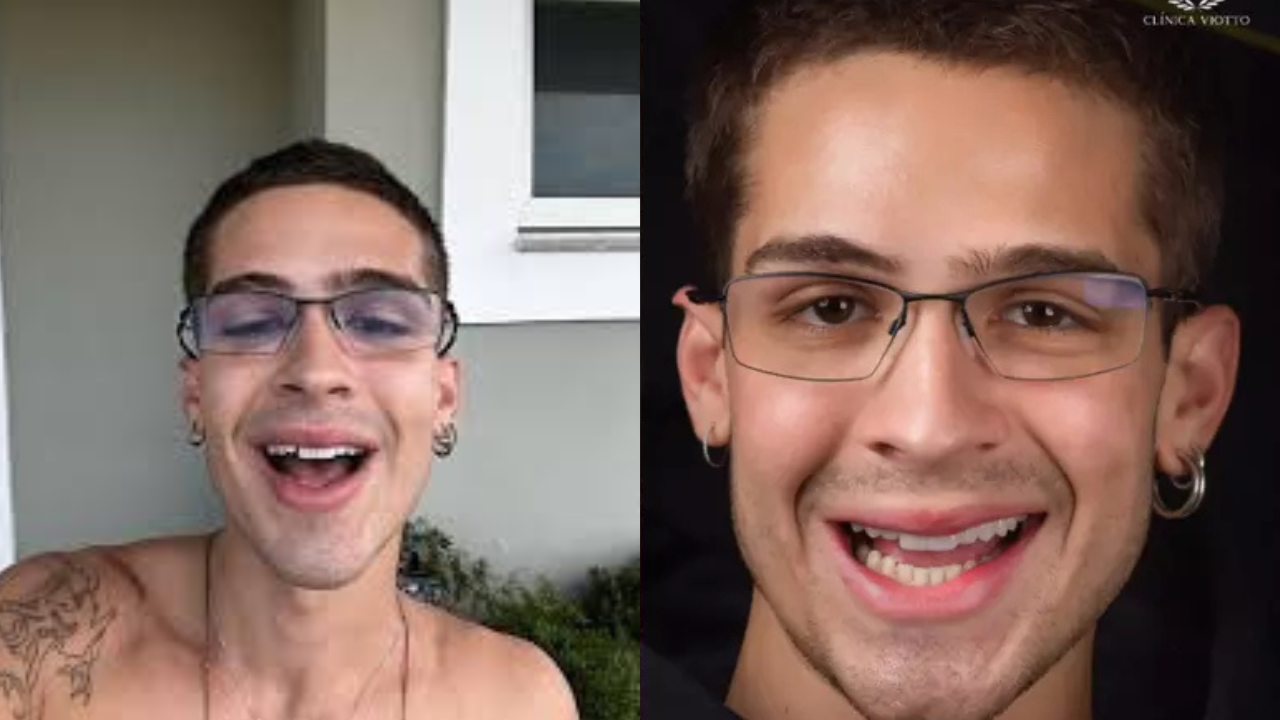 Nova Tendência: João Guilherme aderiu sorriso natural com lentes dentais menos brancas