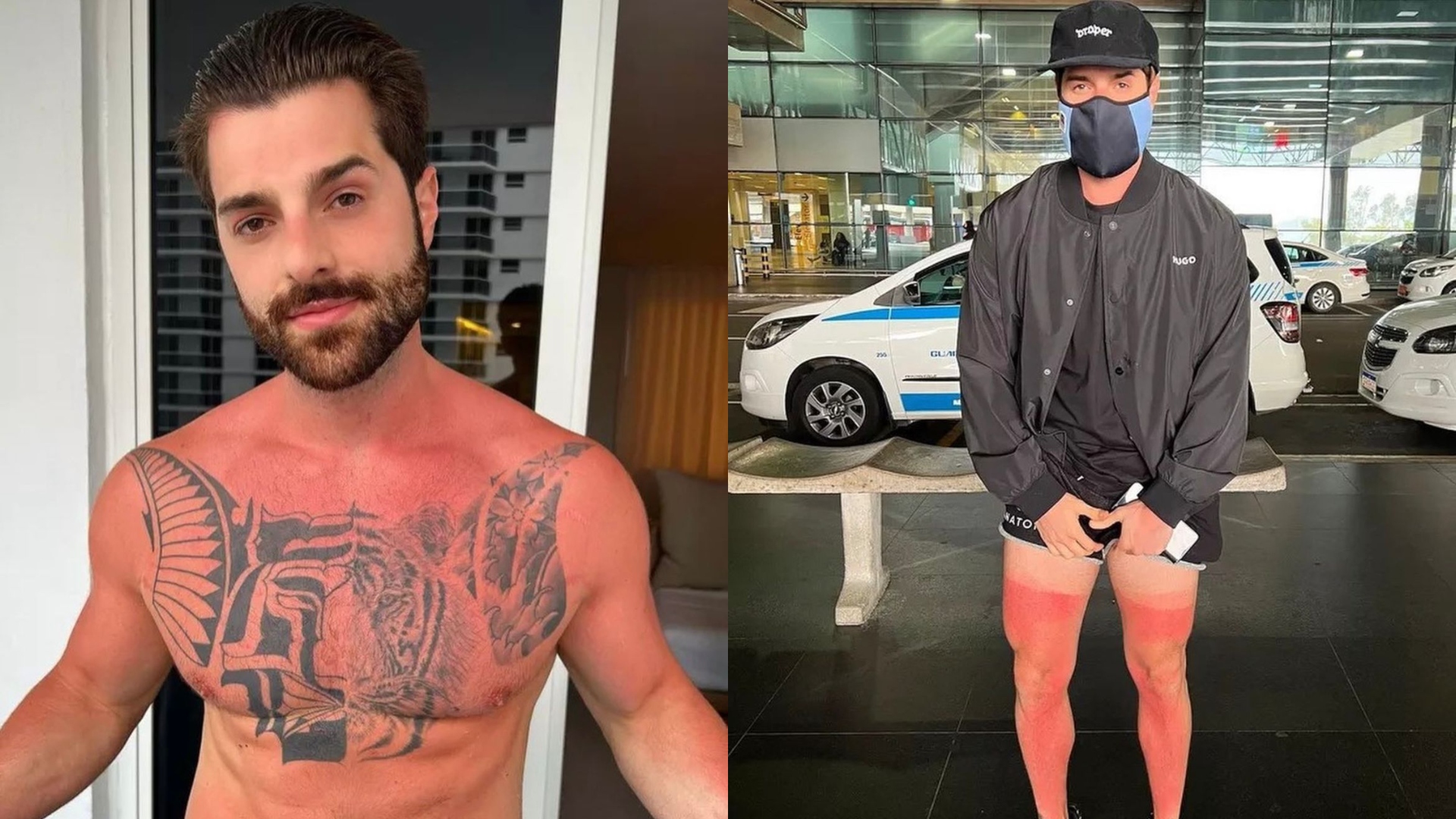 Alok tem queimaduras por falta de protetor solar; Especialista explica a importância do produto