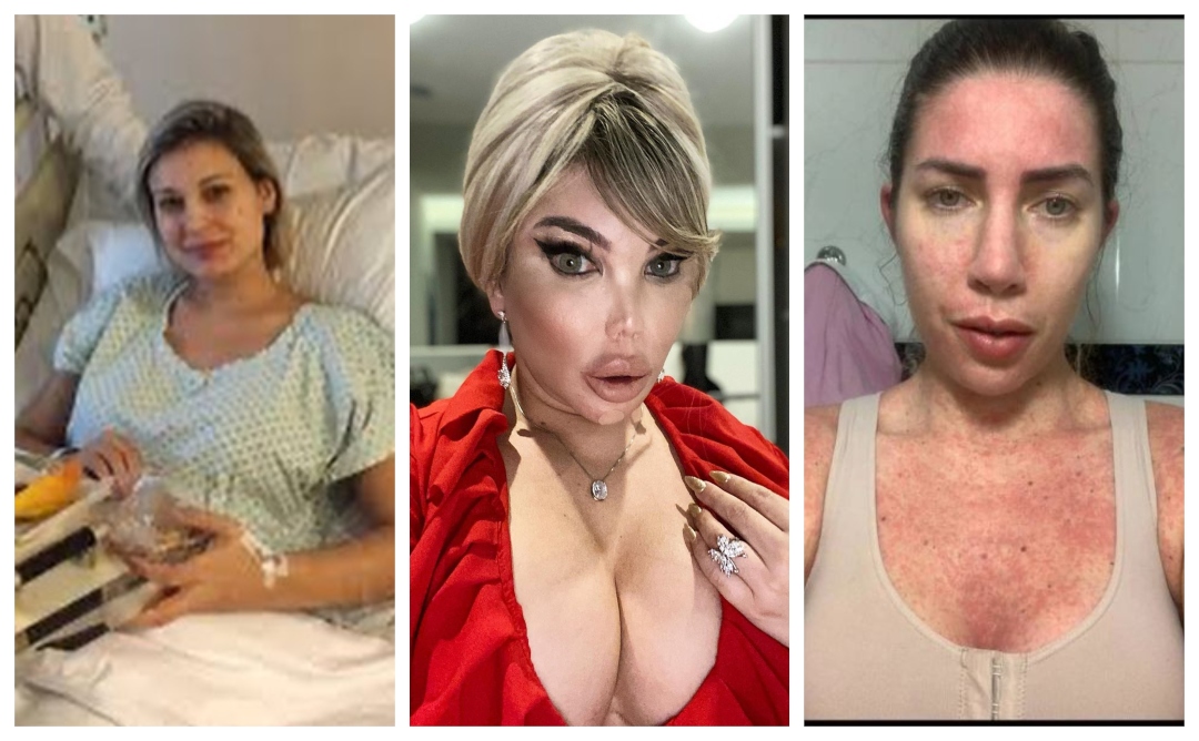 Renasceram! Relembre as famosas que quase perderam a vida por conta de cirurgias plásticas