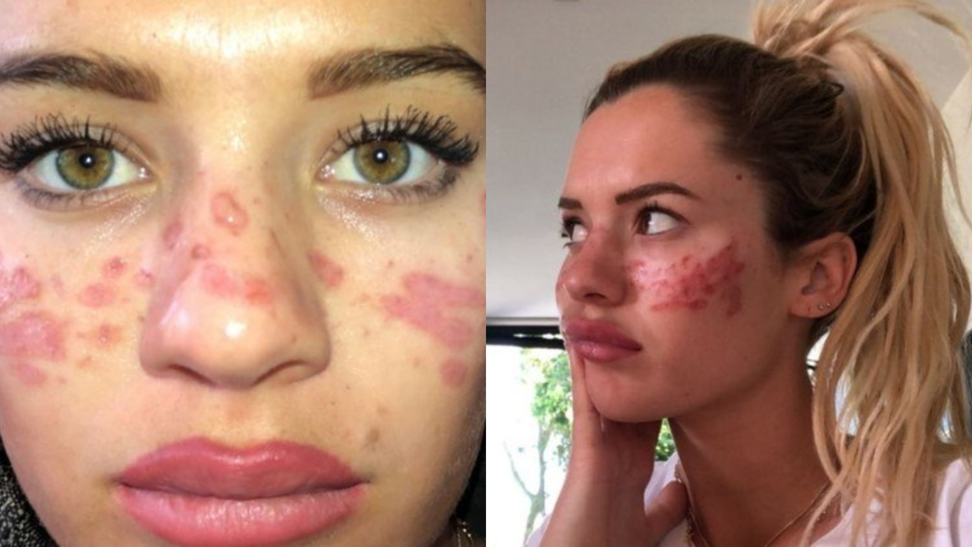 Dermatologista alerta sobre os riscos dos procedimentos caseiros