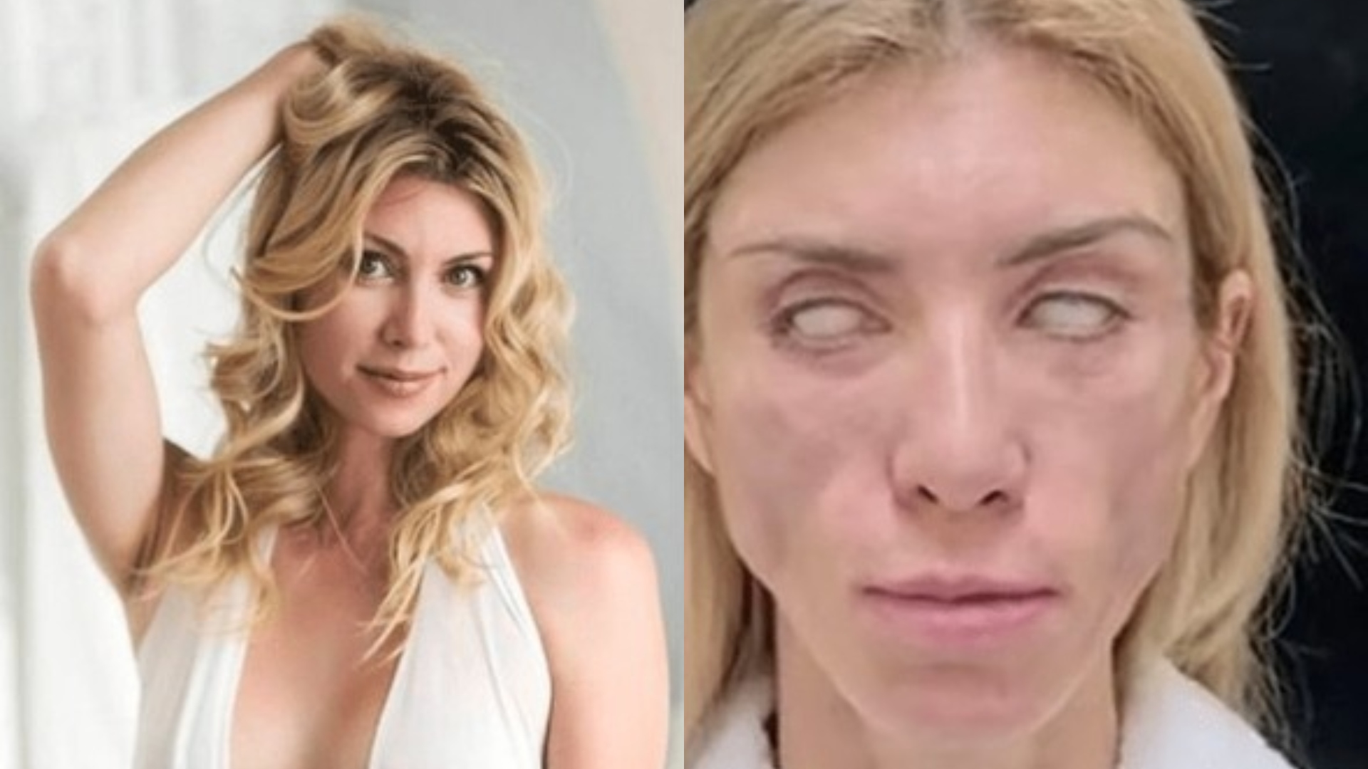 Modelo não consegue fechar os olhos e sorrir após cirurgia plástica