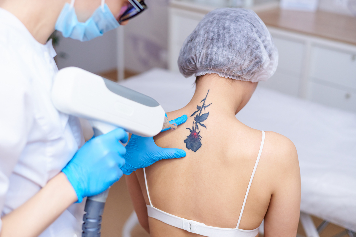 5 dúvidas frequentes sobre remoção de tatuagem