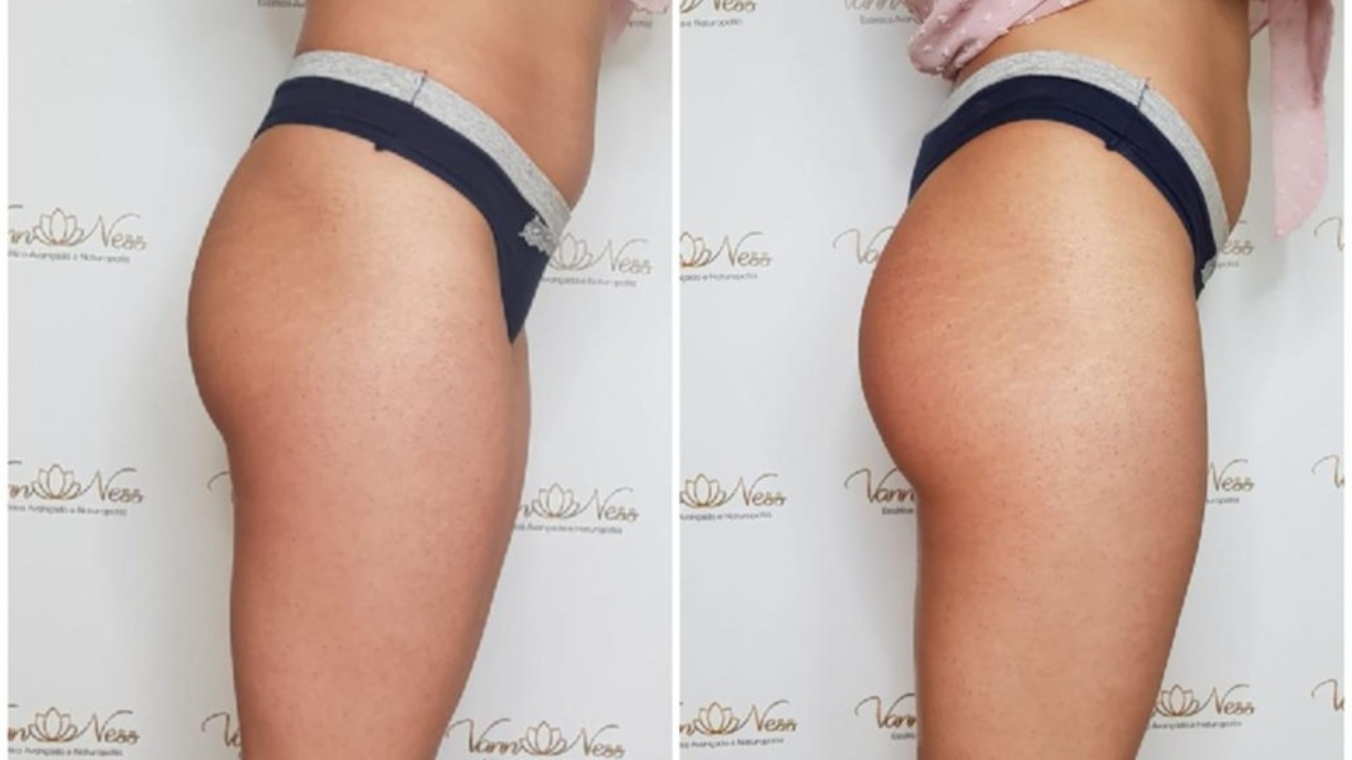 Expert Vanessa Paula declara que já fez harmonização facial em bumbum de paciente para primeira noite de sexo no casamento