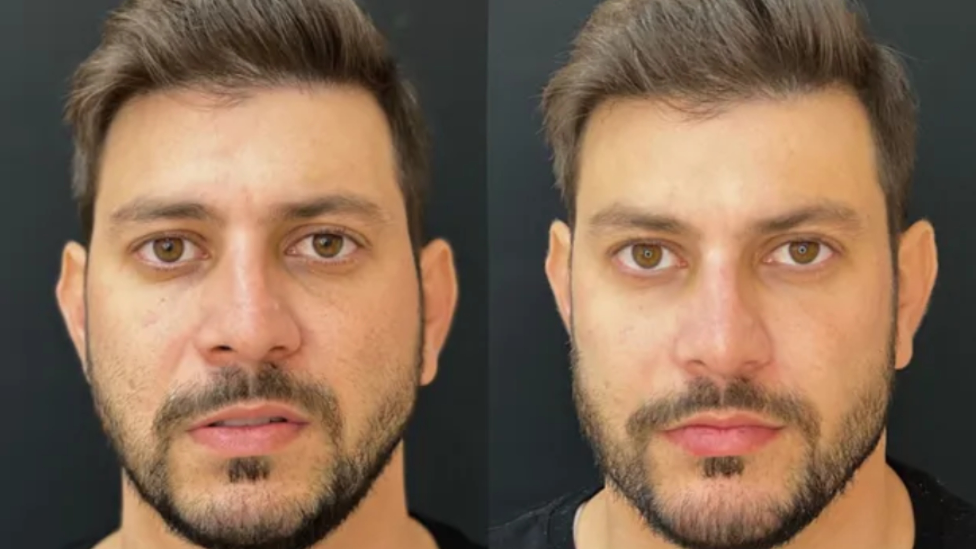Caio Afiune faz harmonização facial; Veja fotos do antes e depois