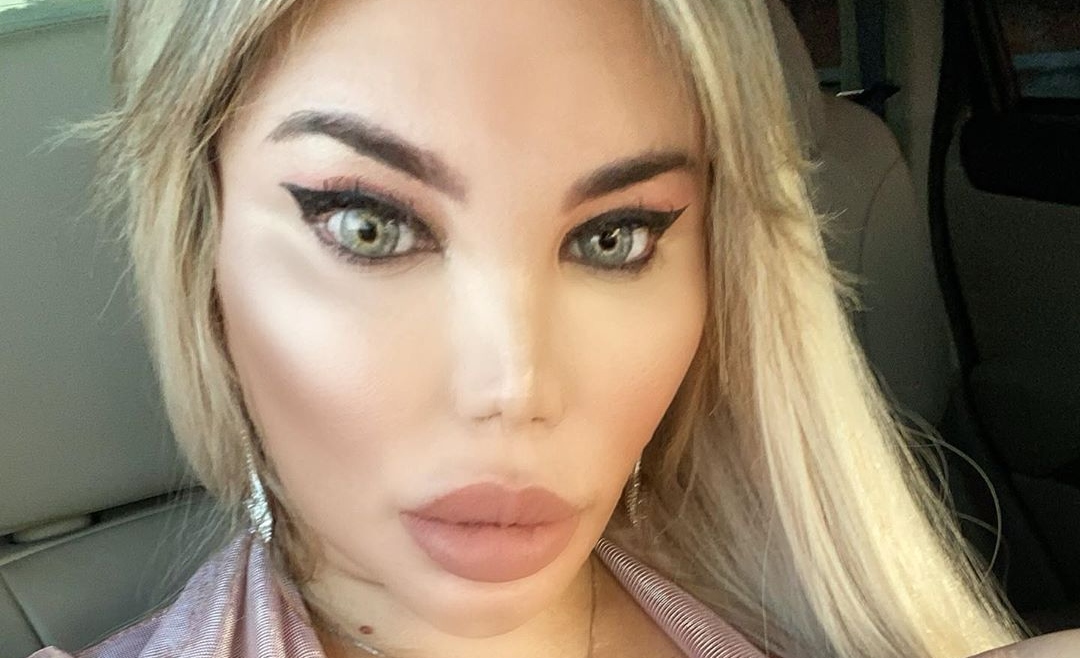 Deu ruim! Ex-Ken humano, Jessica Alves, mostra buraco no queixo após preenchimento com ácido infeccionar: “Culpa é minha”