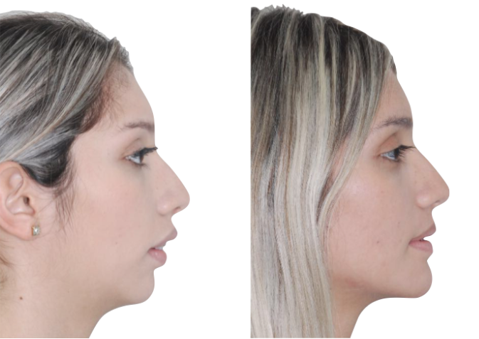 Cirurgia ortognática