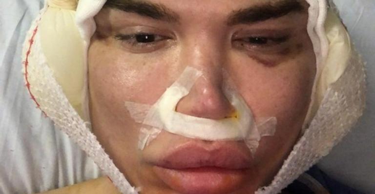 Após complicações, Ken humano anuncia sua 65ª cirurgia plástica