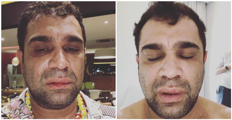 Humorista Evandro Santo é agredido por ex-dependente químico em banheiro: ”Vou atrás dos meus direitos”