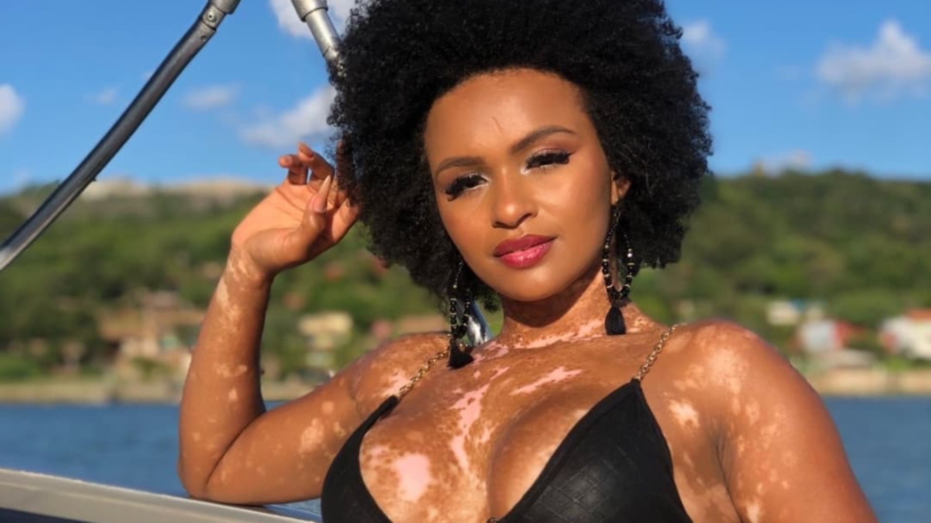 Vitiligo: especialista em dermatologia explica sobre a doença que afeta sister do ‘BBB22’