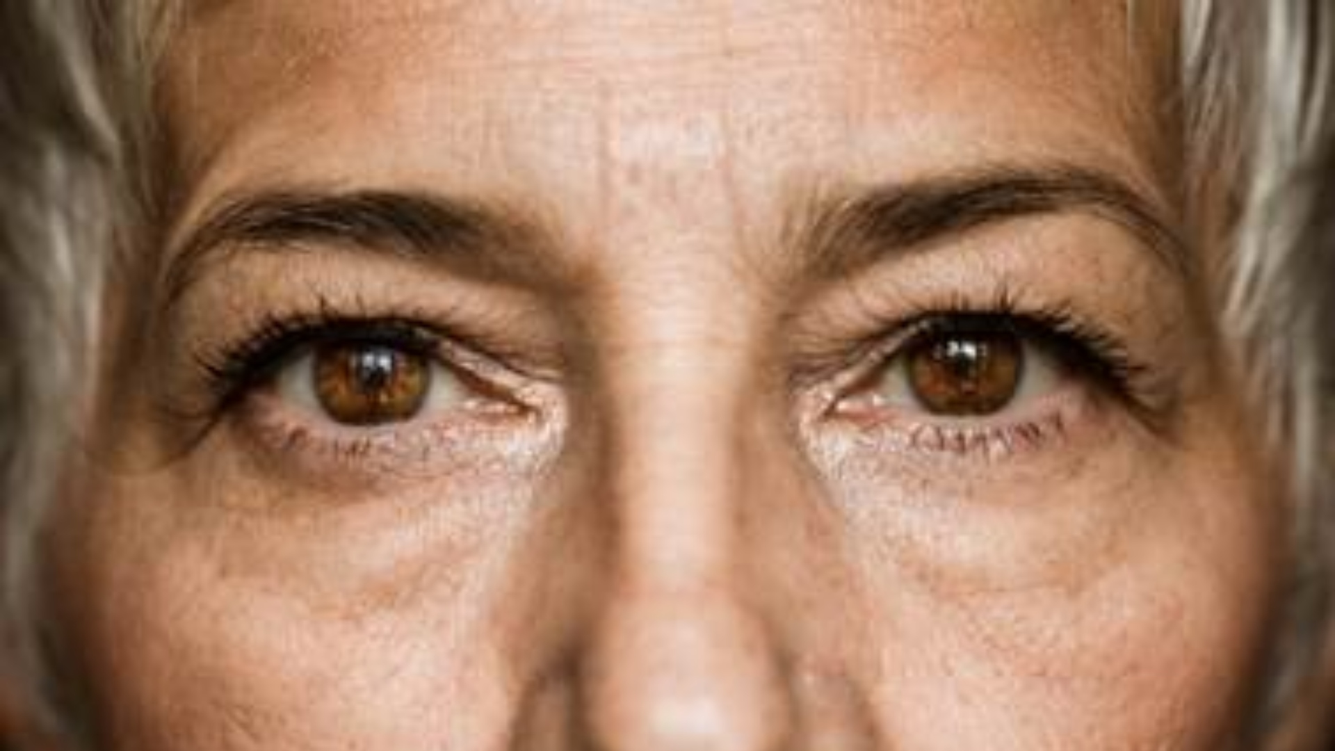 Melasma: dermatologista dá dicas de prevenção e como tratar as manchas na pele