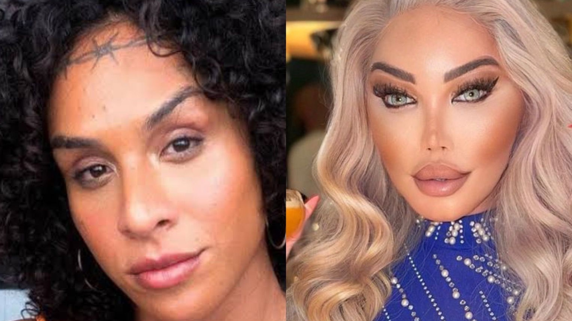 Feminização facial: Especialista explica sobre técnica destinada às mulheres trans