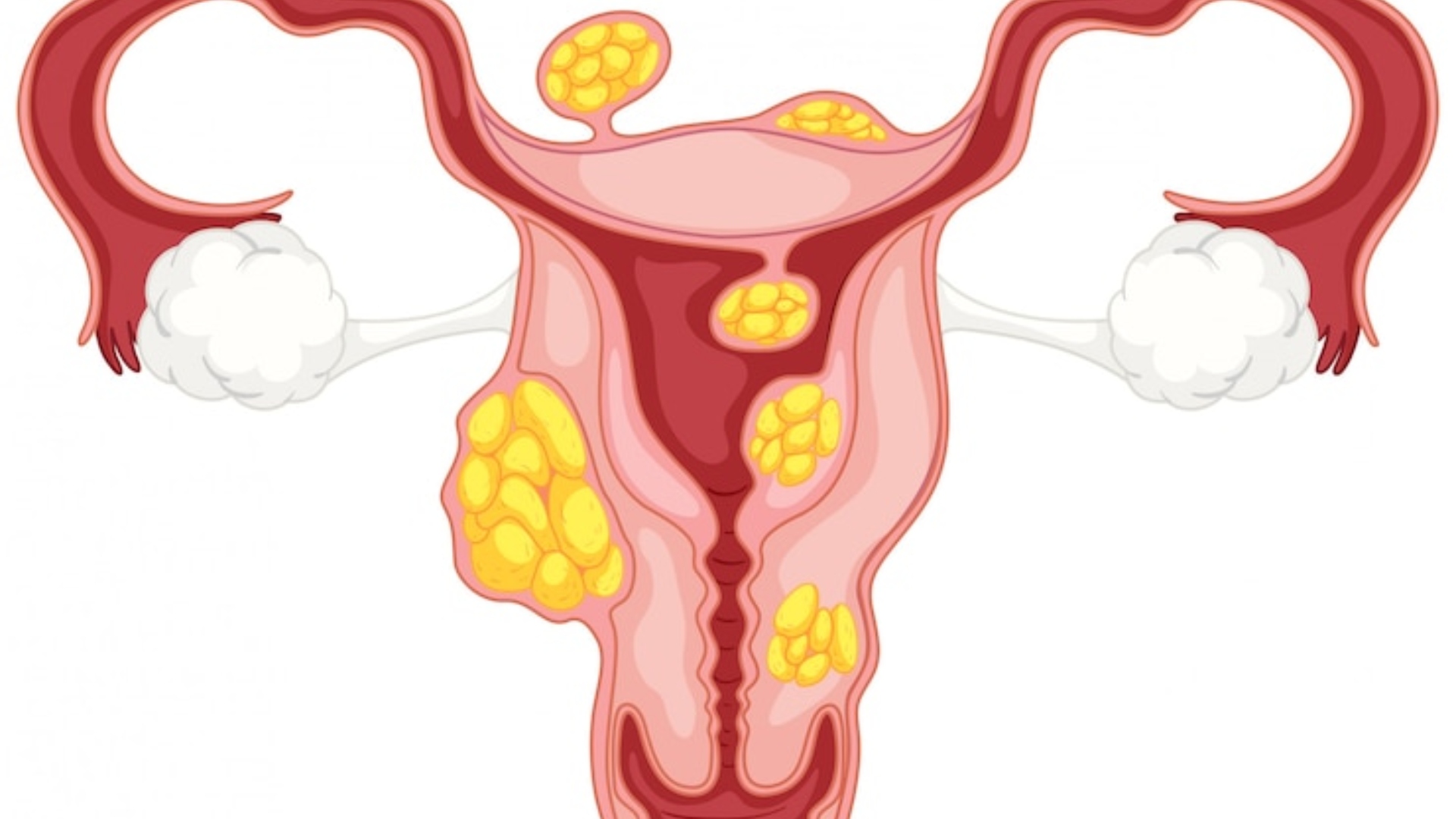 Miomas uterinos: Especialista tira principais dúvidas sobre a condição